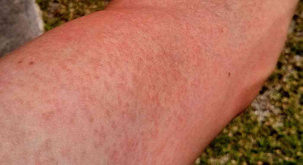 Skin damaged by tanning bed rash